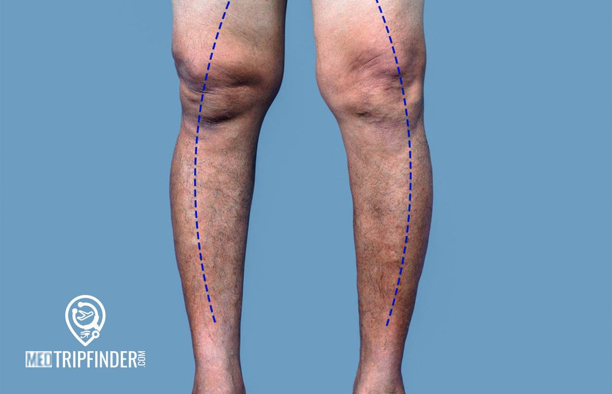Bowed-legs-treatment 
