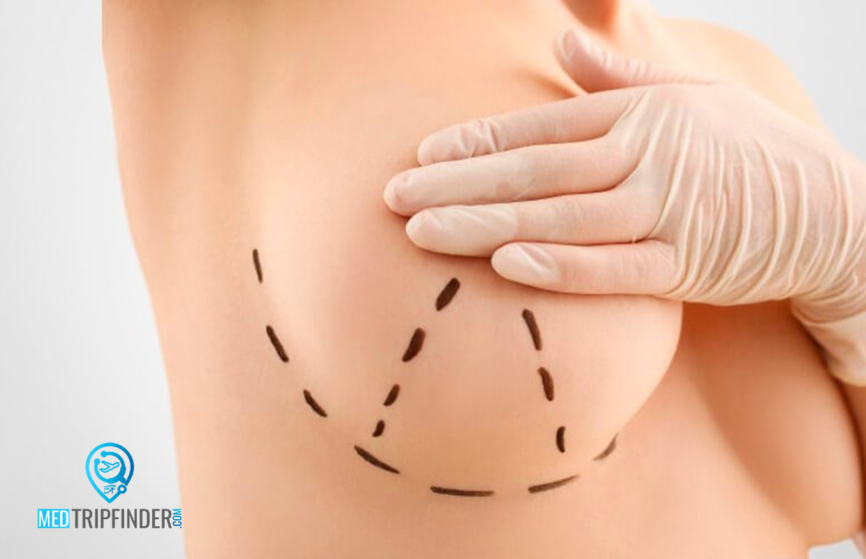 Breast-Lift-Procedures-in-Egypt