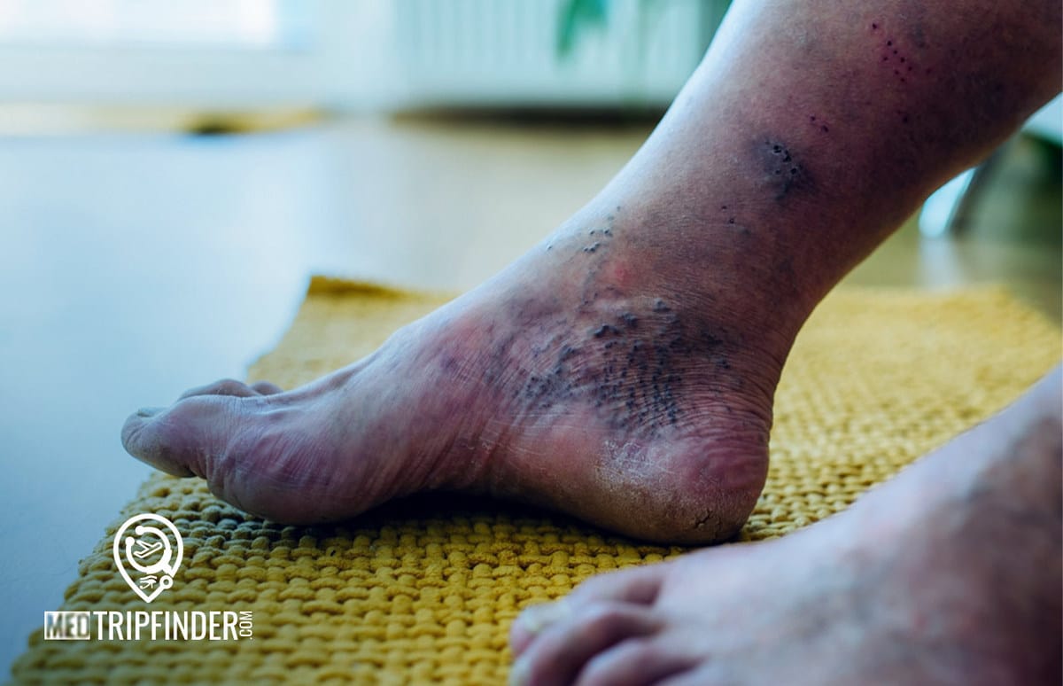 Diabetic-Foot-Treatment