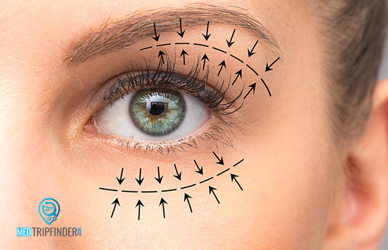 Eyelid-Lift-in-Egypt