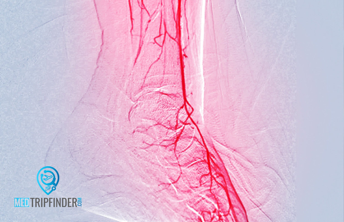 Foot-artery-blockage
