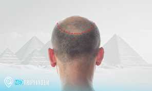 Hair-Transplantation-in-Egypt
