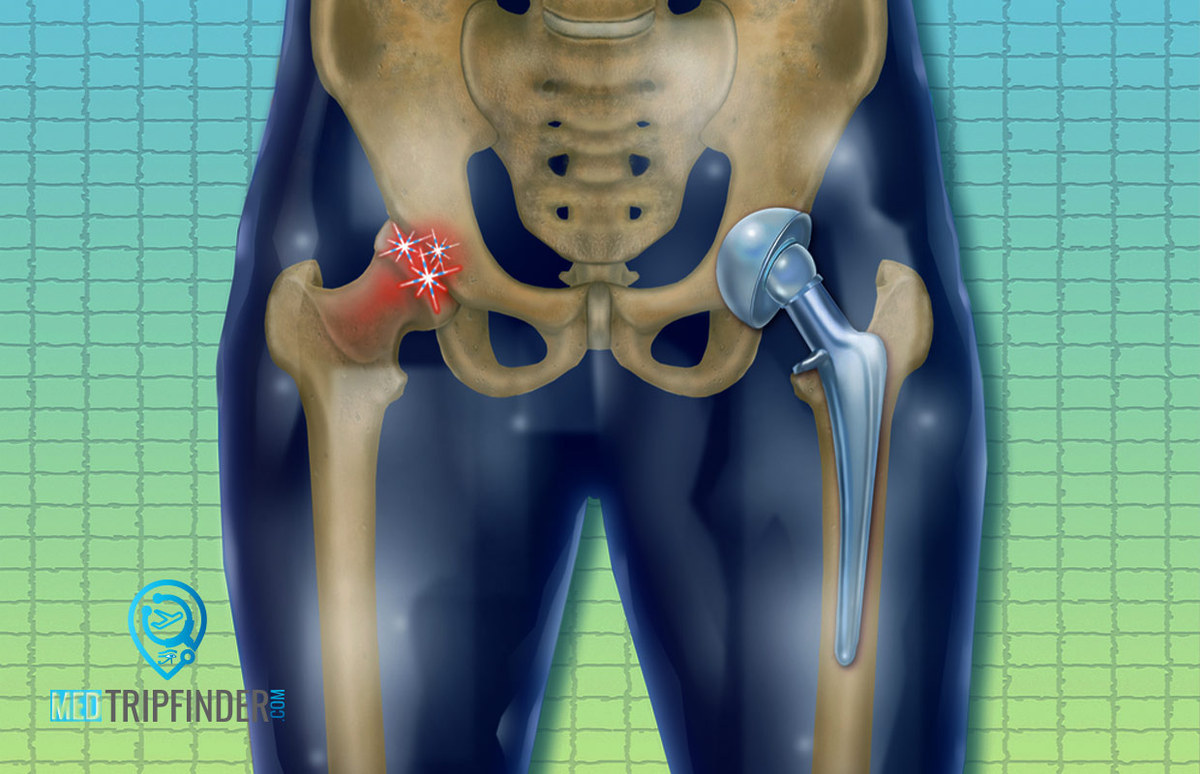 Hip-replacement-surgery