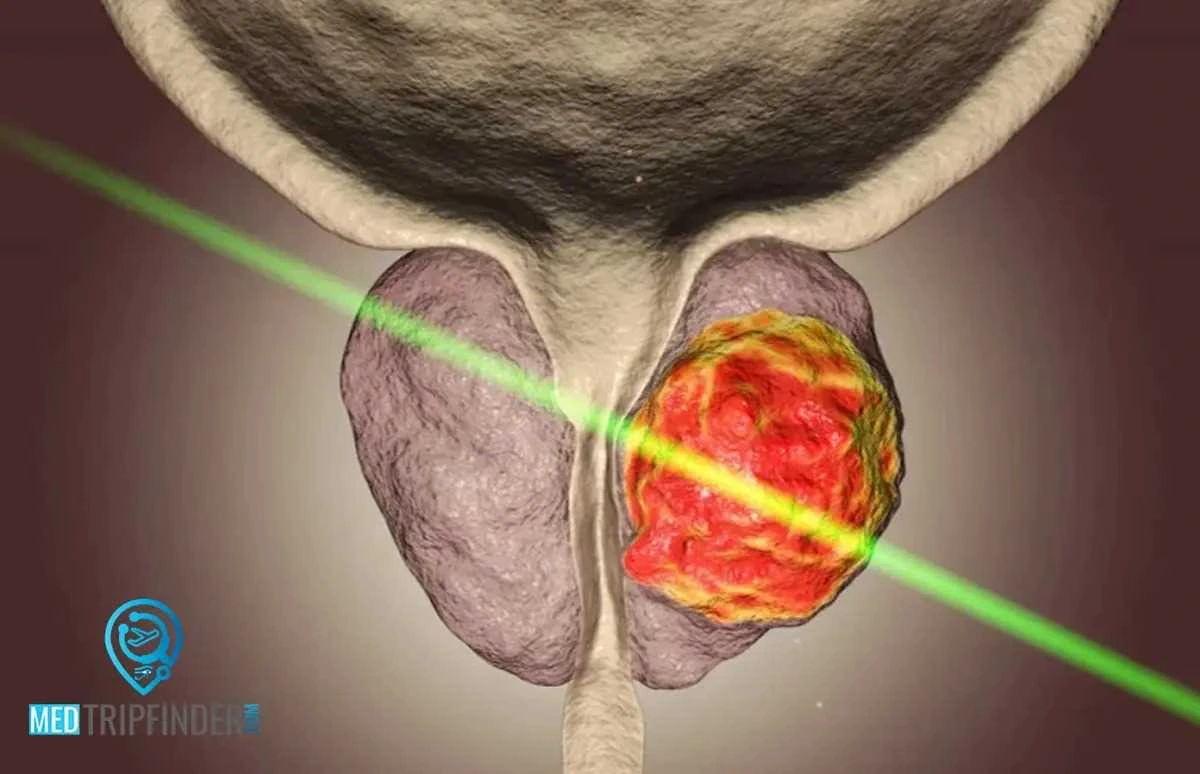 Laser-Treatment-for-BPH