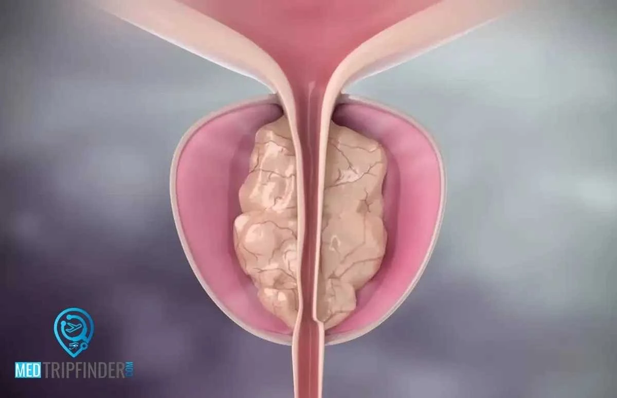 Prostate-Vaporization