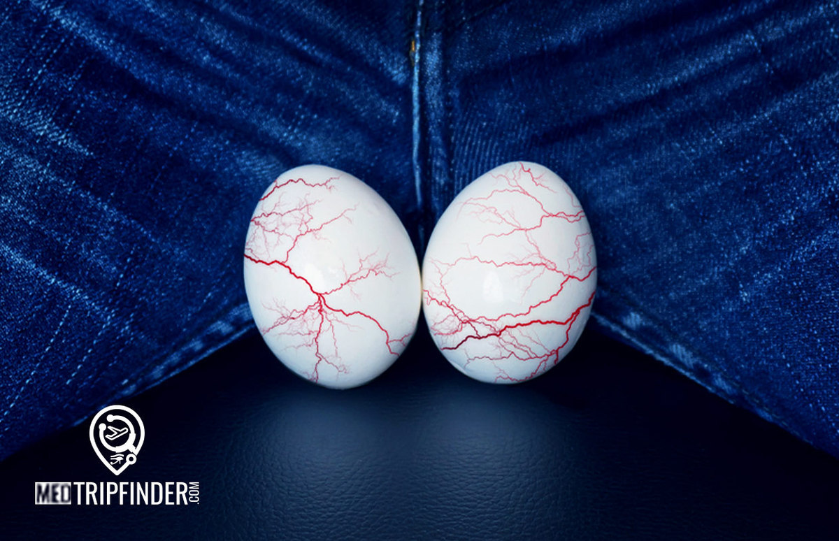 Varicocele-Treatment