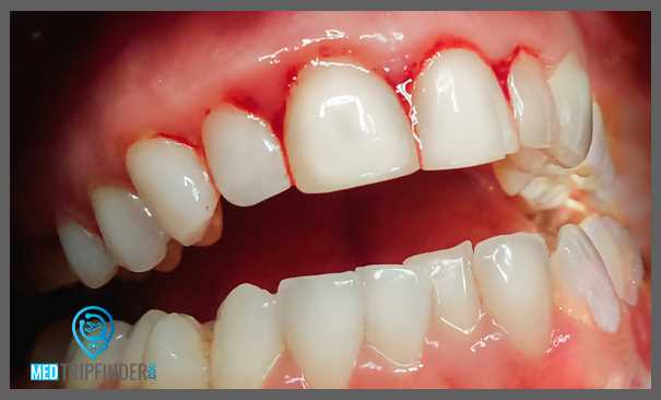 علاج-نزيف-اللثة علاج-نزيف-اللثة